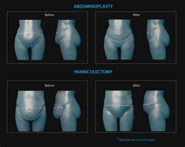 When is a Panniculectomy medically necessary?