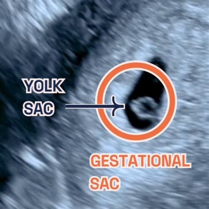 When is the sac visible on ultrasound?