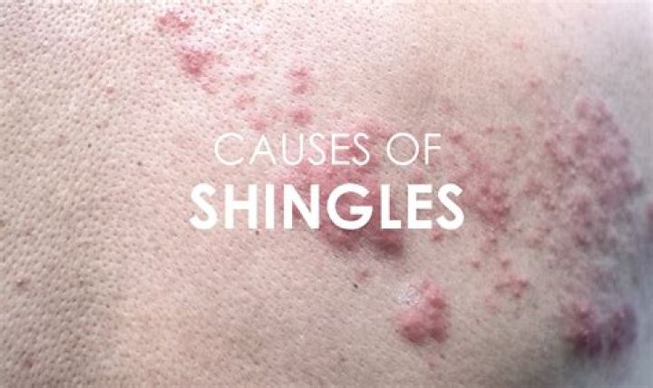 Where did shingles originate from?