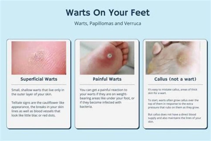 Where does the wart virus live?
