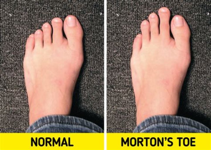 Which is the rarest foot shape?