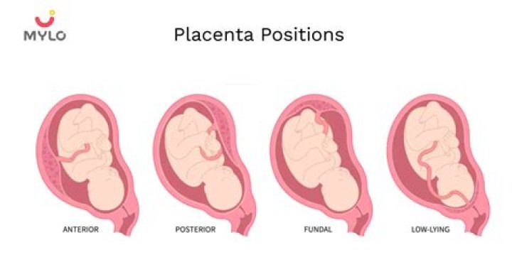 Which placenta position is best?