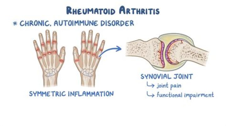 Which type of arthritis is the most painful?