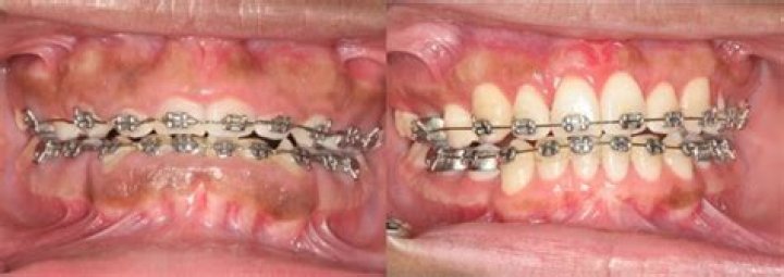 Why are my gums growing over my braces?