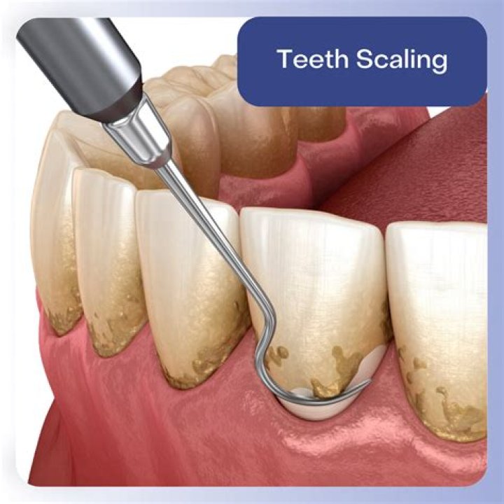 Why do dentists tap on teeth?