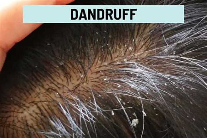 Why do I have huge flakes of dandruff?