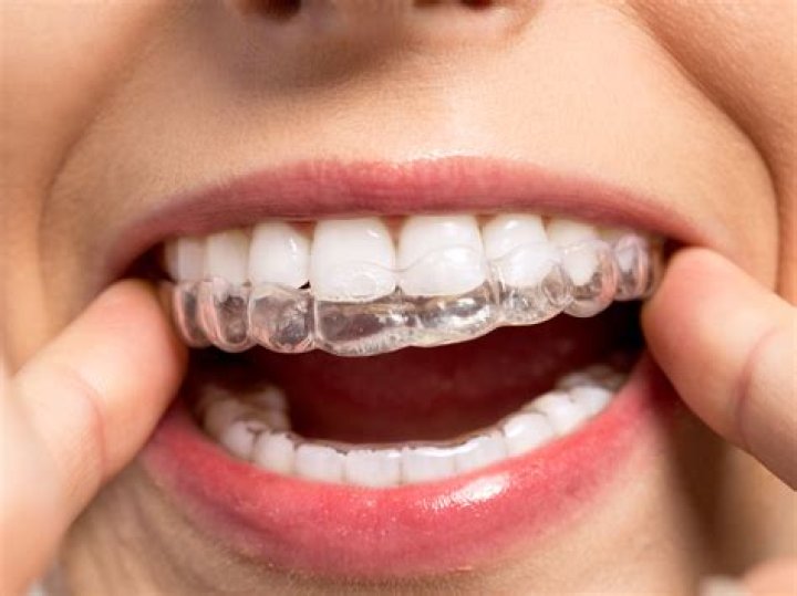Why do my teeth look worse during Invisalign?