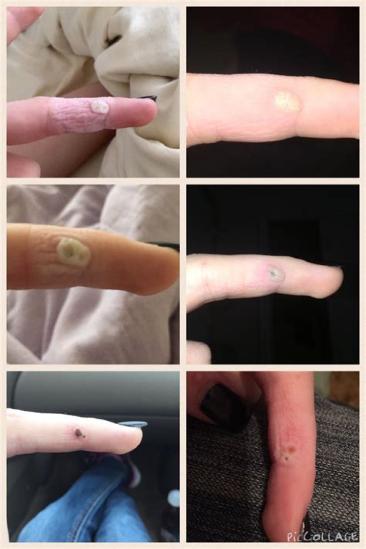 Why do warts turn white?