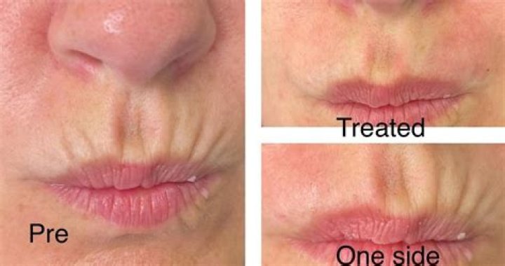 Why do you get a ring around your lips?