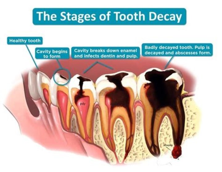 Why does my tooth hurt but no cavity?