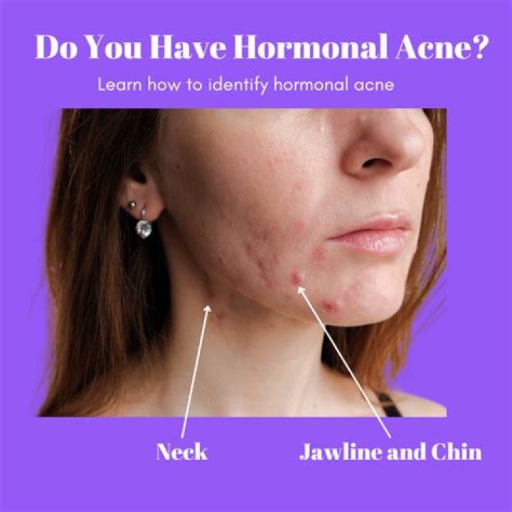 Why is hormonal acne on chin?