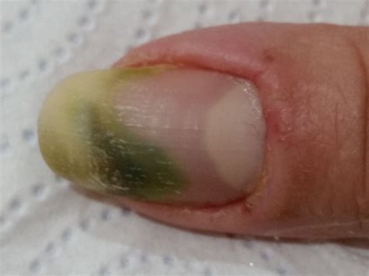 Why is my nail green?