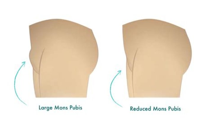 Why is my pubic mound so large?