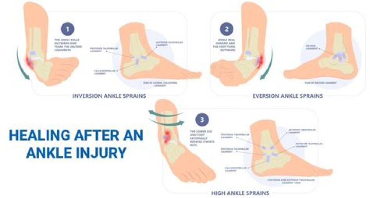 Why is sprained ankle not healing?