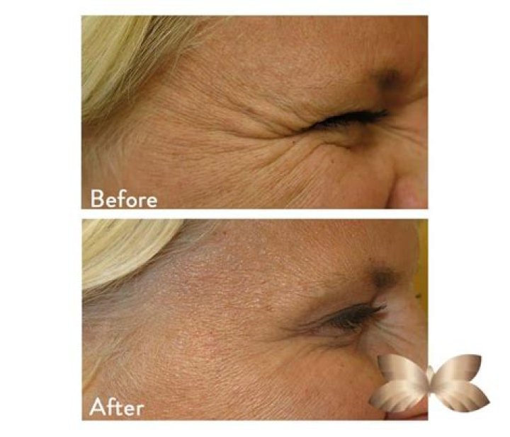 Will massaging wrinkles help?